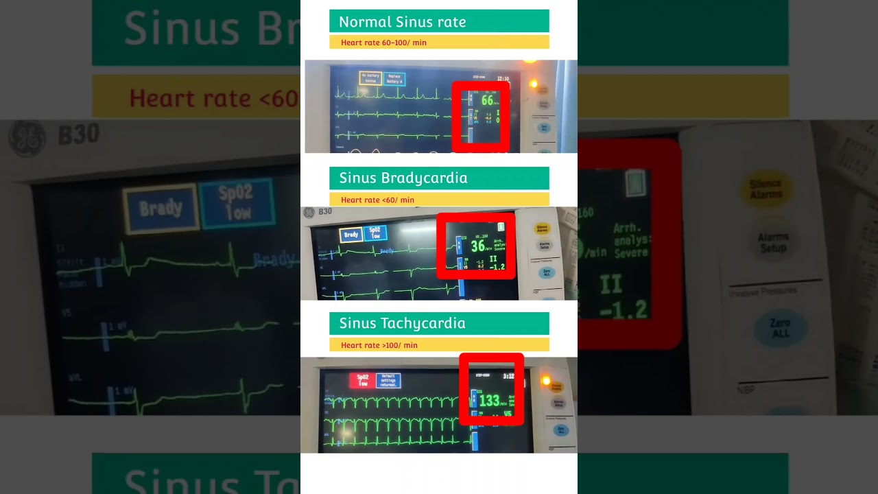 Normal Heart rate l Sinus Bradycardia l Sinus Tachycardia #shorts