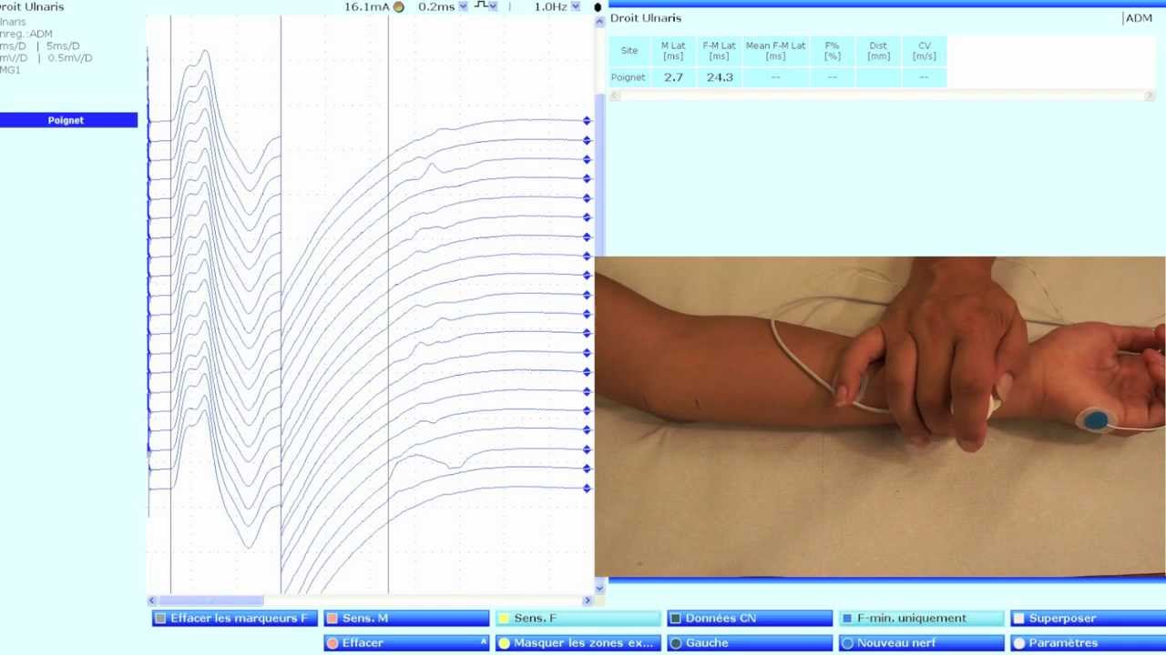 Ulnaire moteur/Muscle abductor digiti minimi (neurographie motrice avec ondes F)