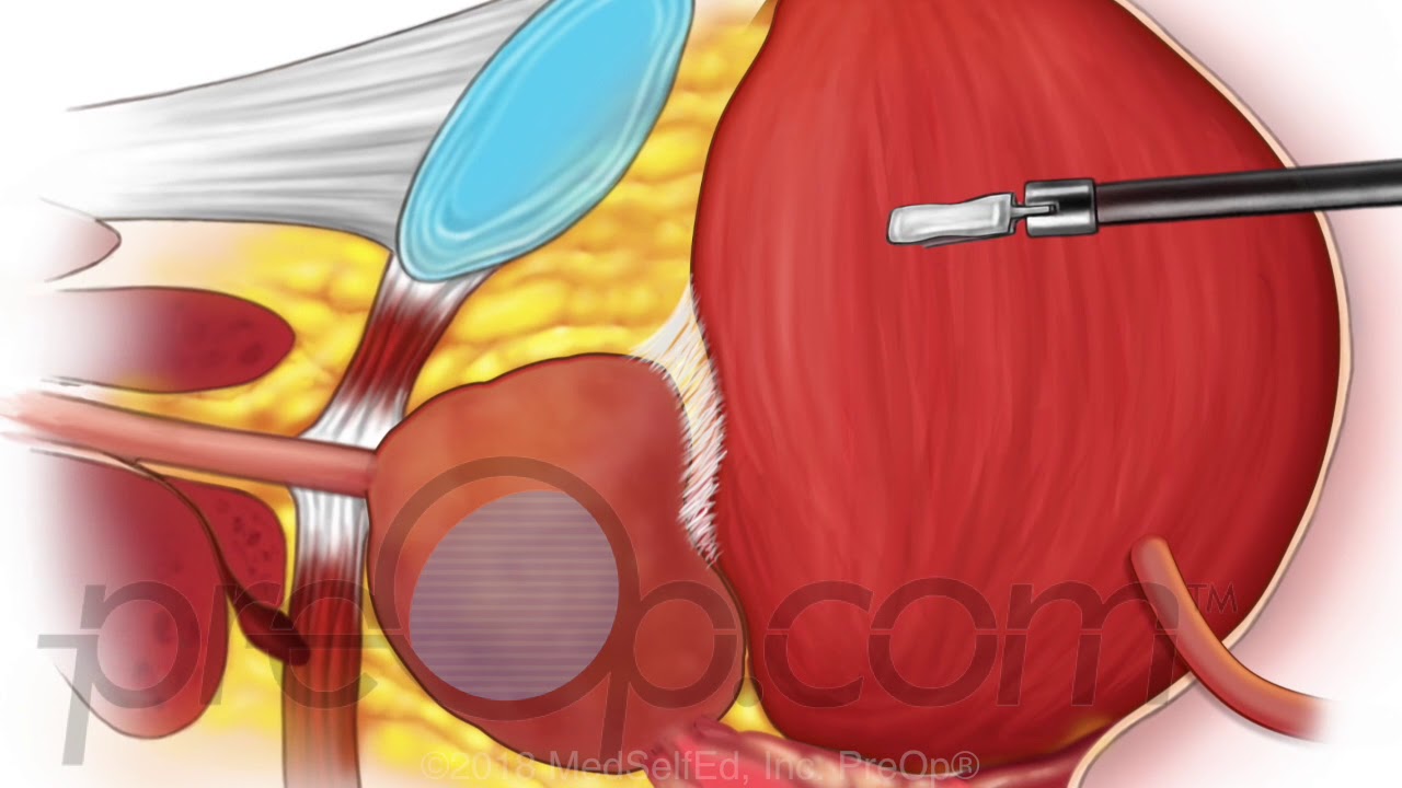 Radical Prostatectomy Surgery • The Procedure  • PreOp Patient Education & Patient Engagement
