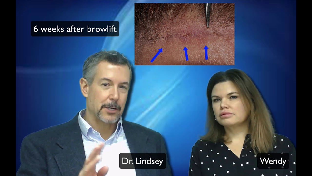 Minimal scarring from trichophytic browlifts by Dr. Lindsey in Washington DC | Virginia | Maryland
