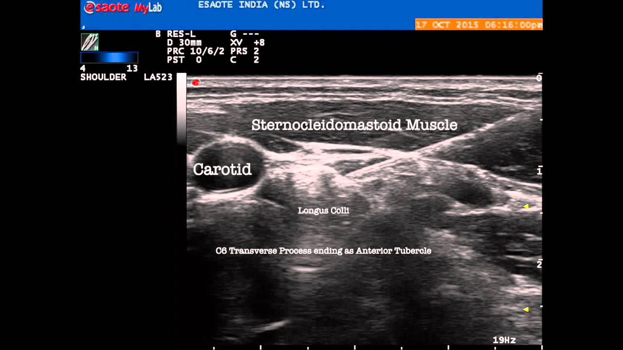 Ultrasound guided Stellate Ganglion for CRPS
