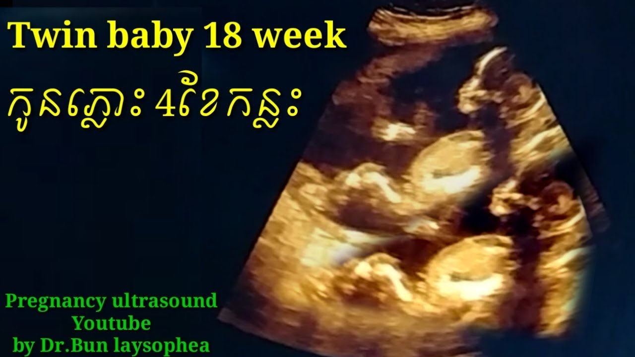 ពិនិត្យអេកូកូនភ្លោះ 4ខែកន្លះ pregnancy ultrasound twin baby 18 week by Dr.Bun laysophea