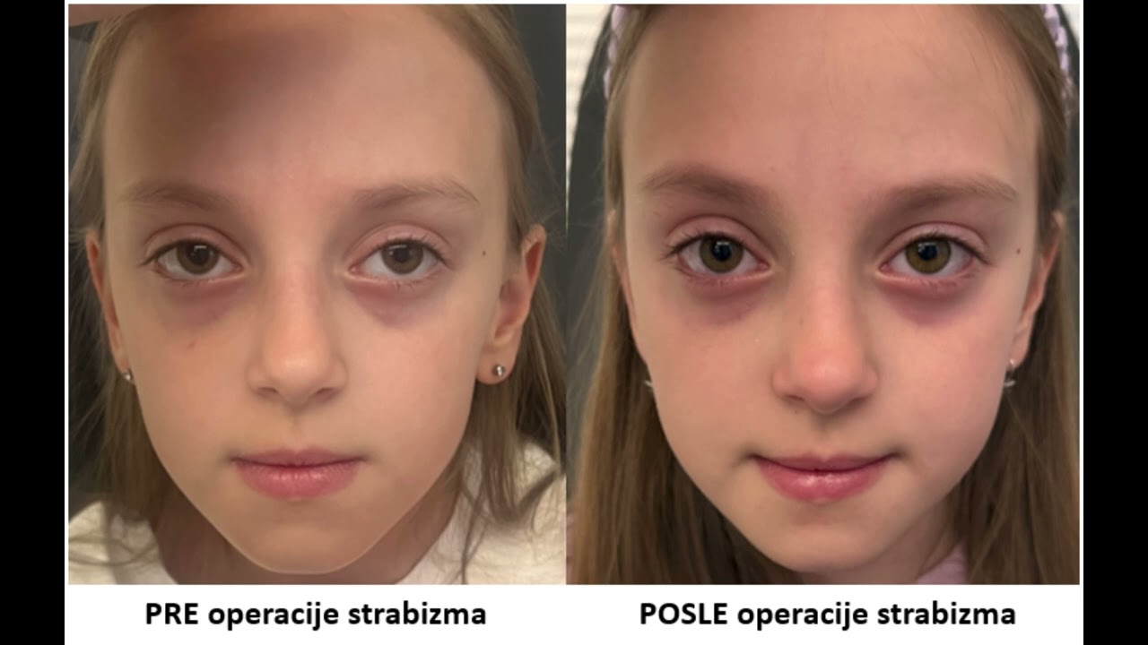 Operacija strabizma kod dece, specijalna bolnica Sveti Vid