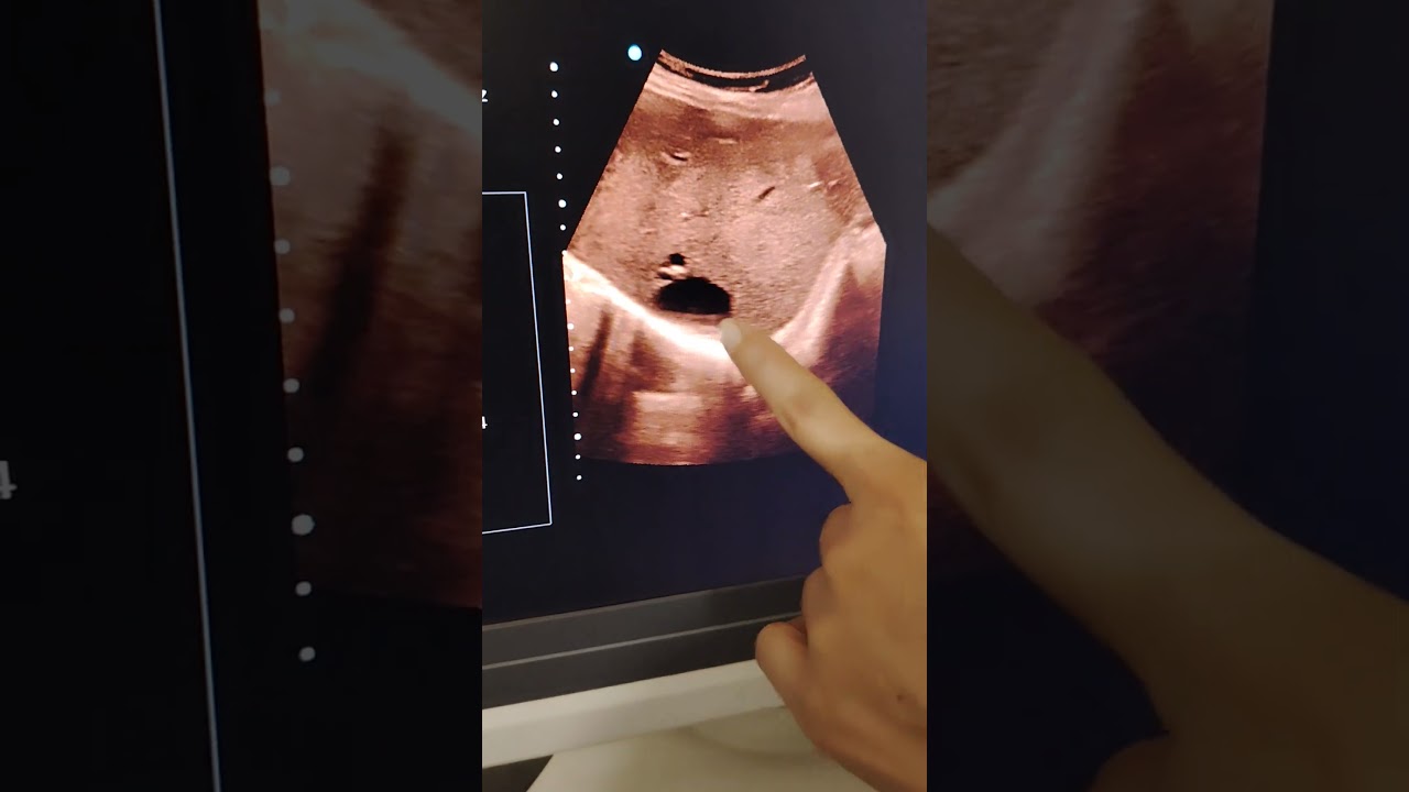 Hepatic cyst in right lobe of liver