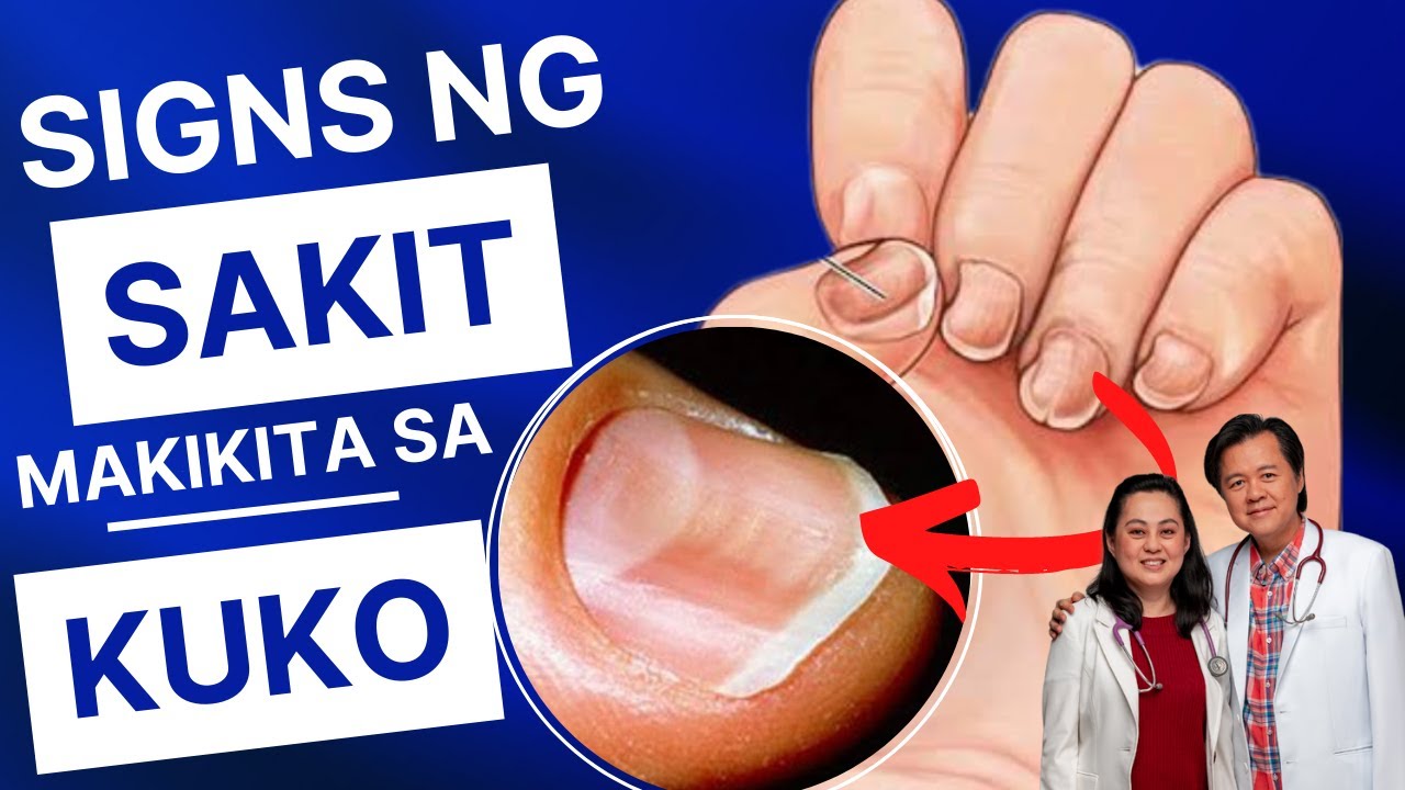 Signs ng Sakit Pwede Makikita sa Kuko - By Doc Willie Ong