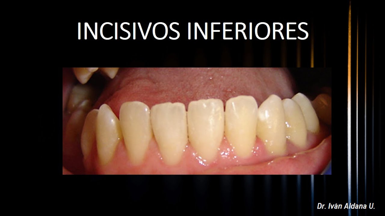 ANATOMÍA DENTARIA: Unidad 2.2: INCISIVOS INFERIORES (parte 1)