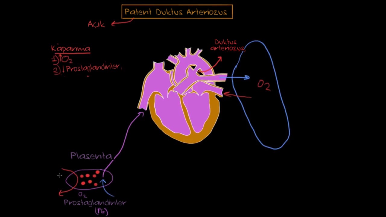 Patent Duktus Arteriozus (Fen Bilimleri) (Sağlık ve Tıp)