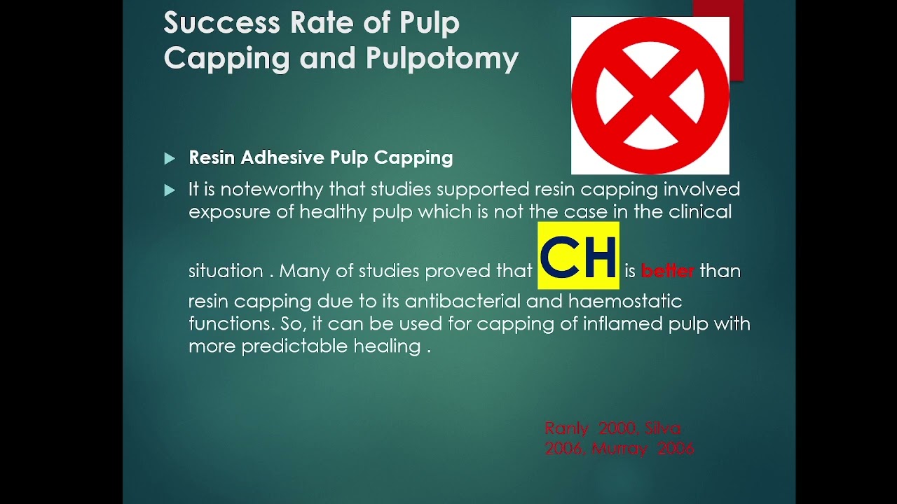 Vital Pulp Therapy Of Mature Permanent Teeth With Irreversible Pulpitis. Dr. Mohammad Alqadry