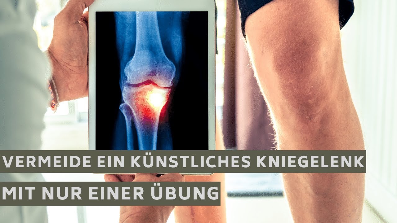 Künstliches Kniegelenk vermeiden - Mit nur einer Übung