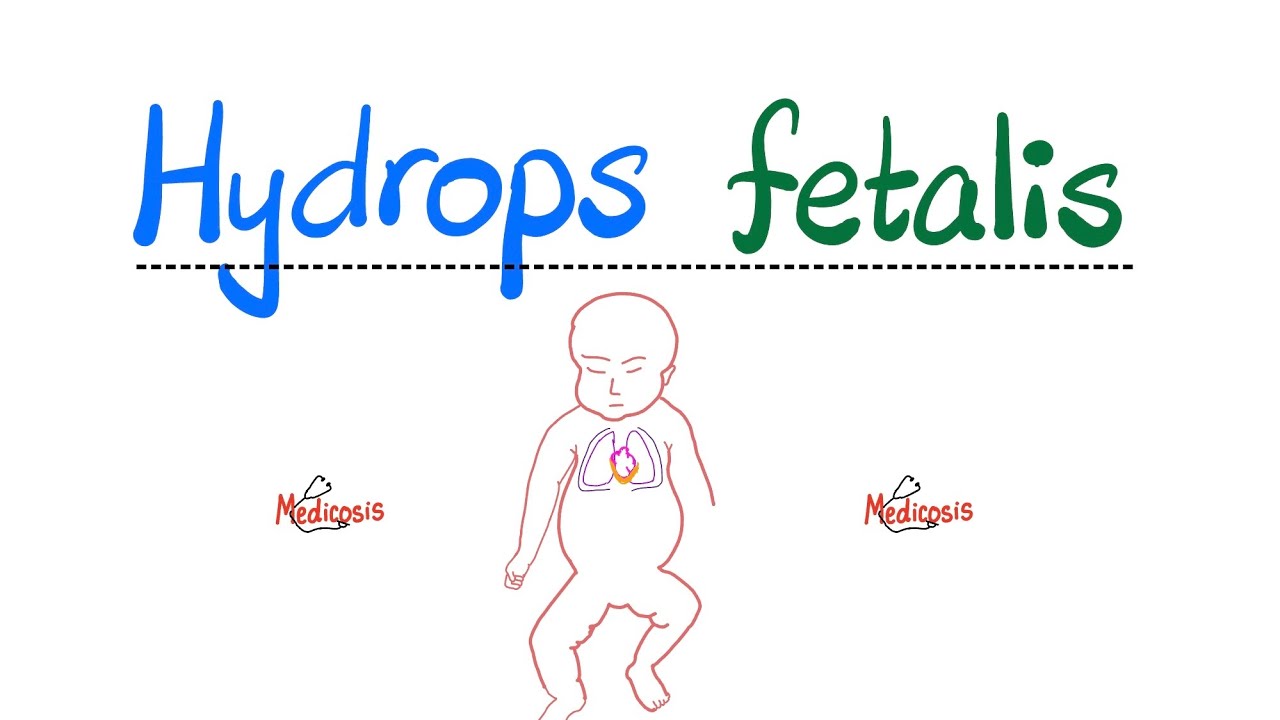Hydrops fetalis