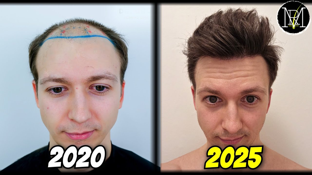 Results of 3 Hair Transplants! 12 months review