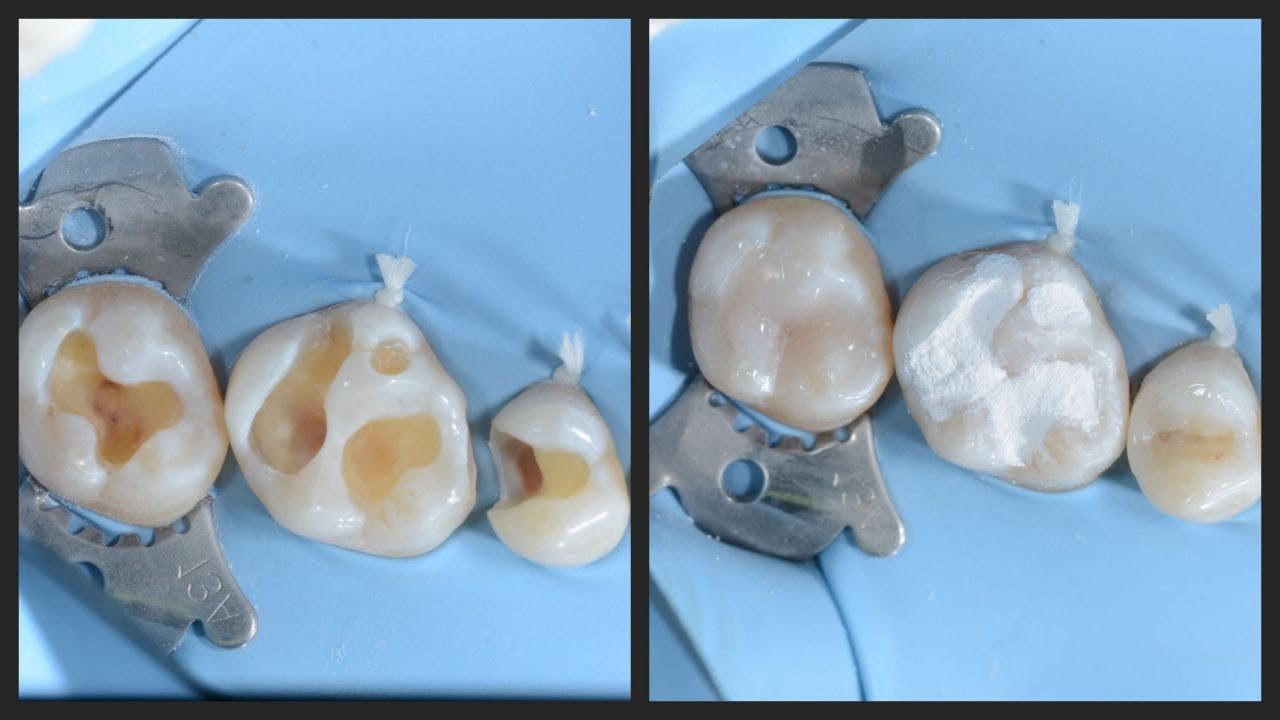 معالجة العاج قبل الحشو المؤقت و عمل risen coatting       Immediate dentine sealing  IDS