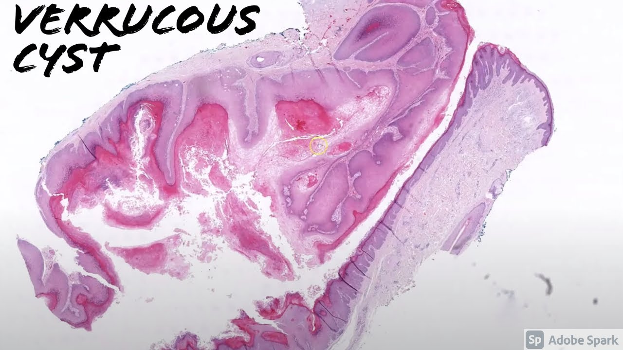 Verrucous Cyst: 5-Minute Pathology Pearls