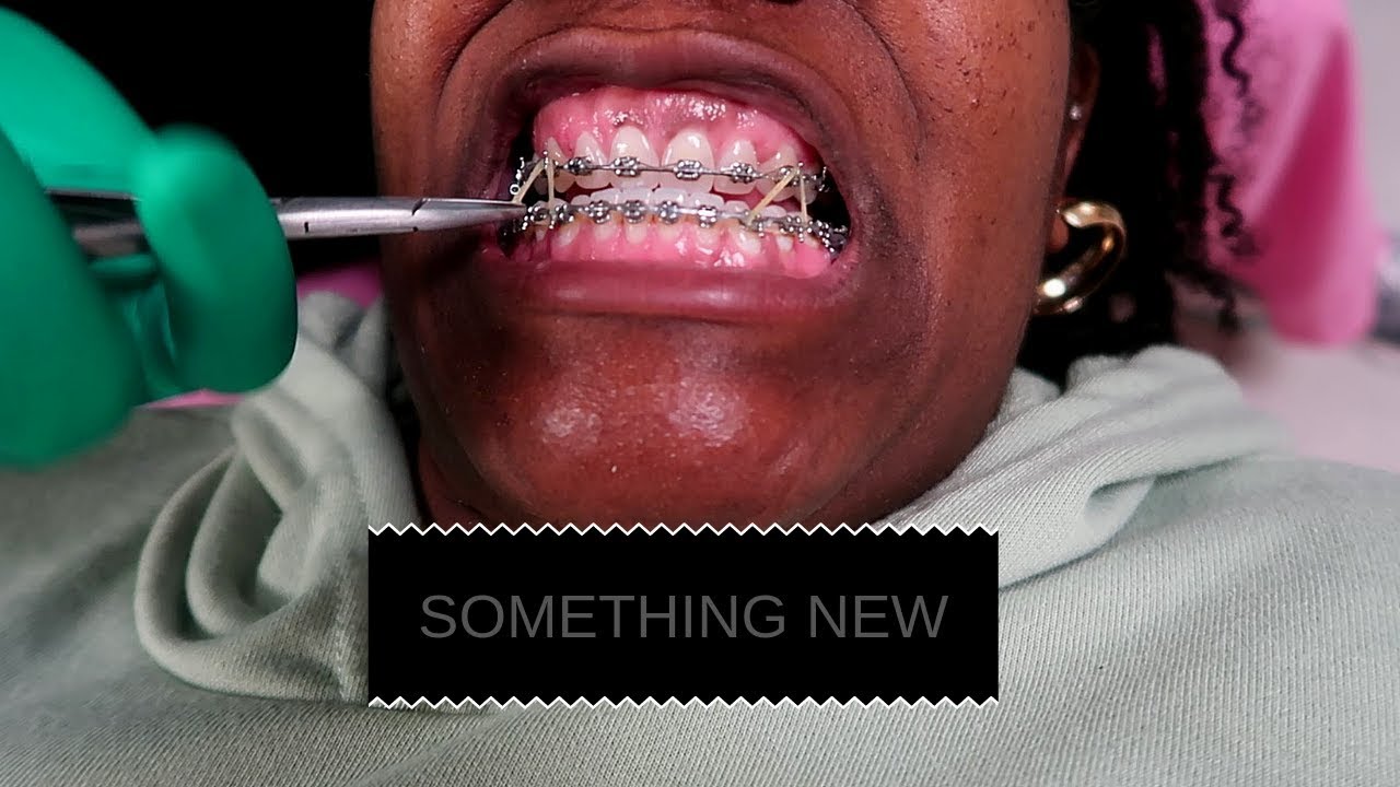 Braces, Power Chains, & Rubber-bands Update 3 | Vlogs