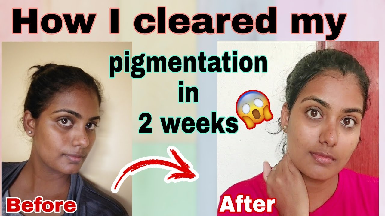 how i got rid of my pigmentation and dark spots | minimalist serum and ponds gel moisturizer review