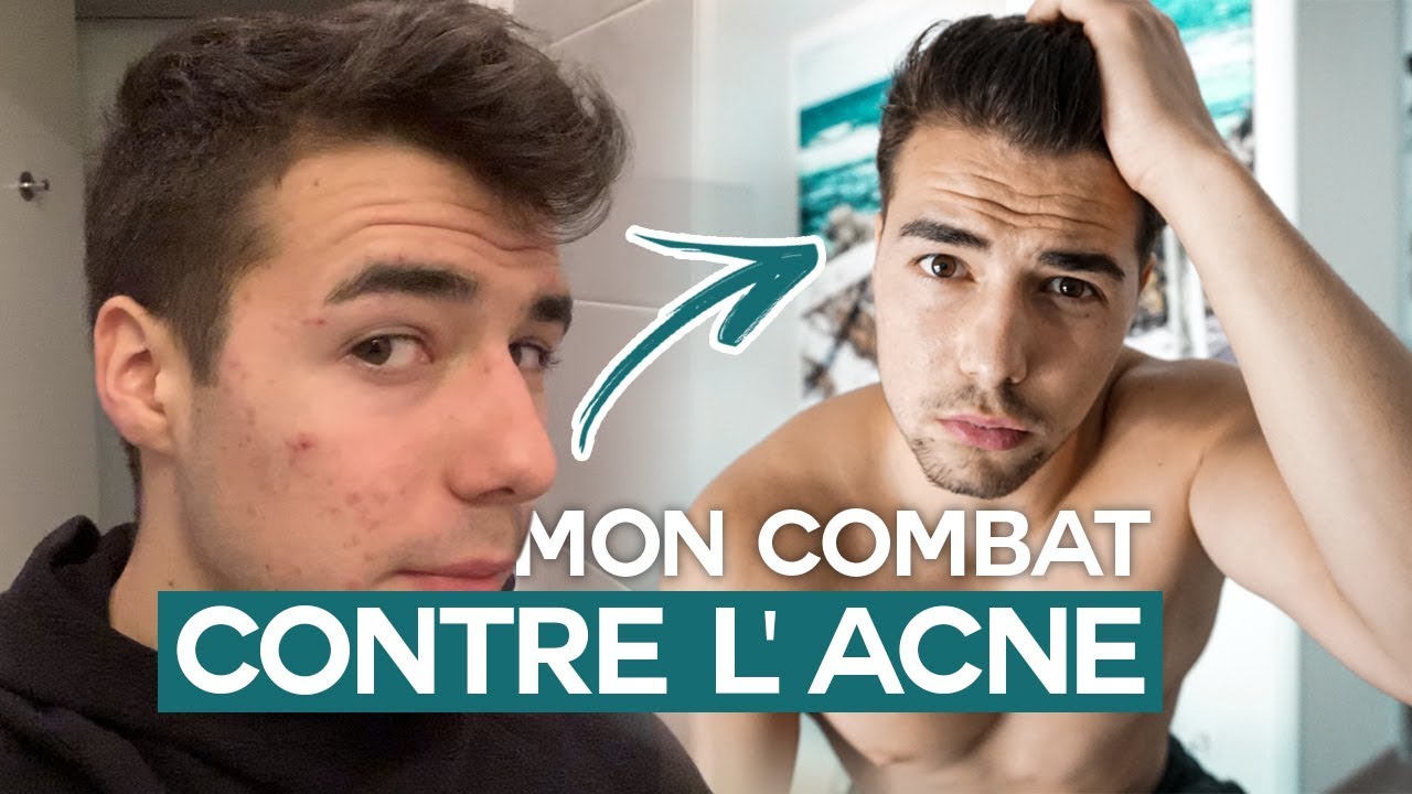 COMMENT JE ME SUIS ENFIN DÉBARRASSÉ DE MON ACNÉ ! (Curacné...)