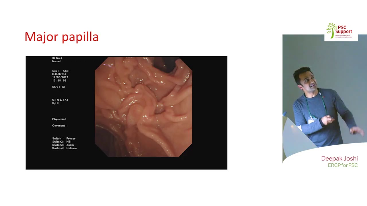 Dr Deepak Joshi - ERCP for PSC