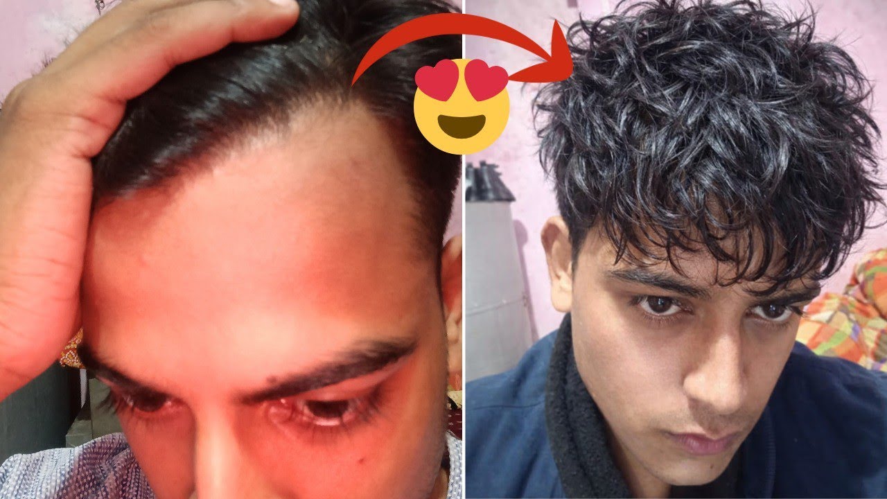I Was Losing My Hair Fast – Until I Tried THIS! Re-upload 