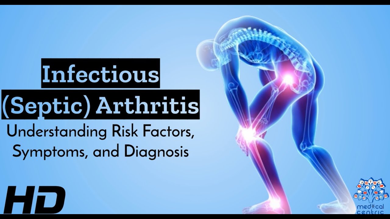 Decoding Infectious Arthritis: Unraveling Risk Factors, Symptoms, and Diagnostics