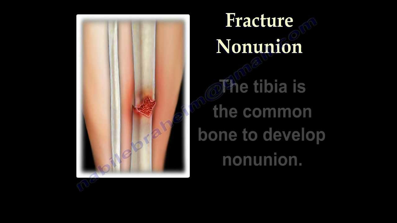 NONUNION OF FRACTURES CAUSES AND TREATMENT - Everything You Need To Know - Dr. Nabil Ebraheim