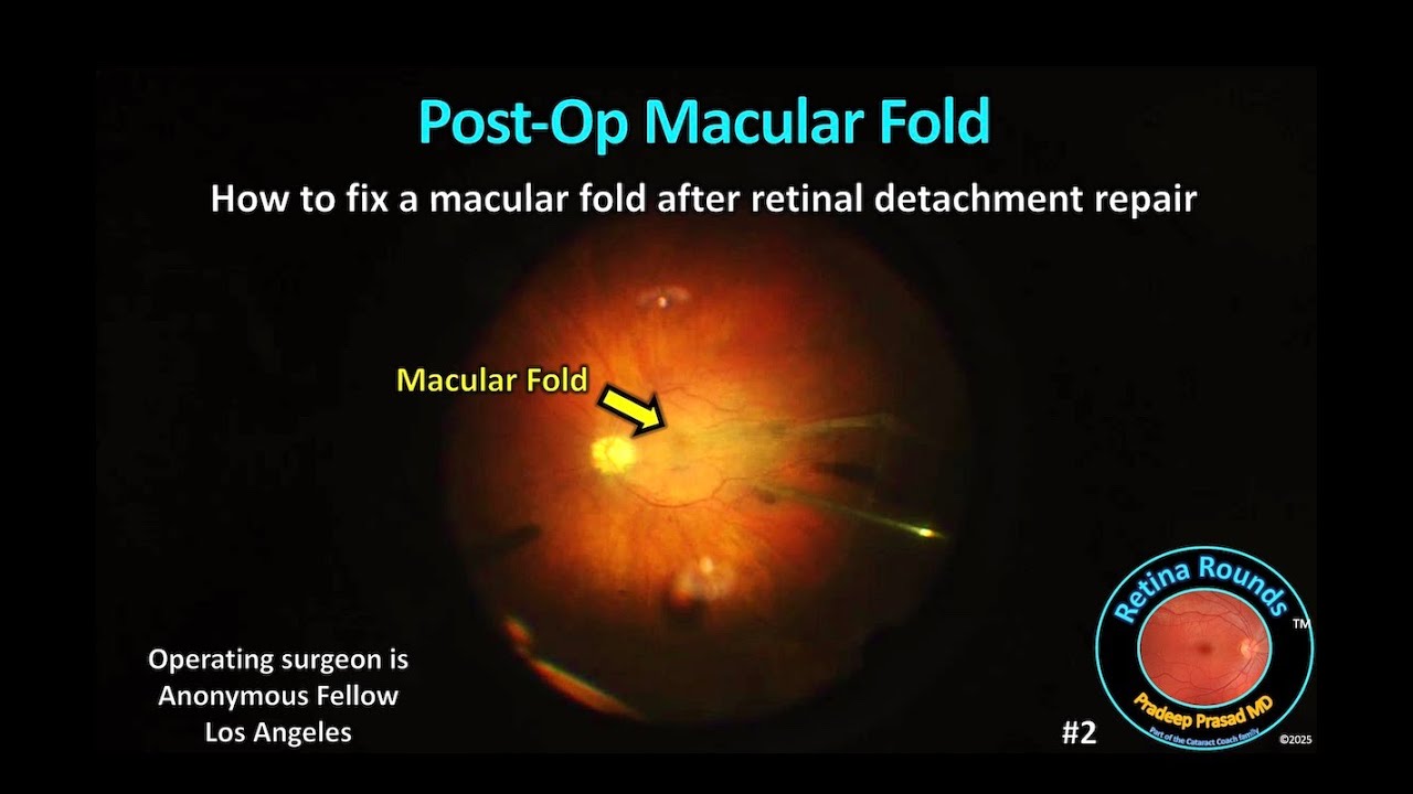 RetinaRounds&trade; 2: Post-op macular fold