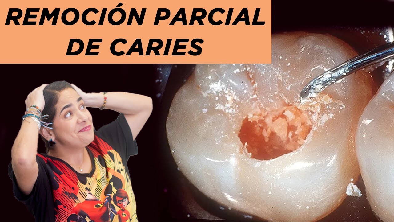 Remoción parcial de caries