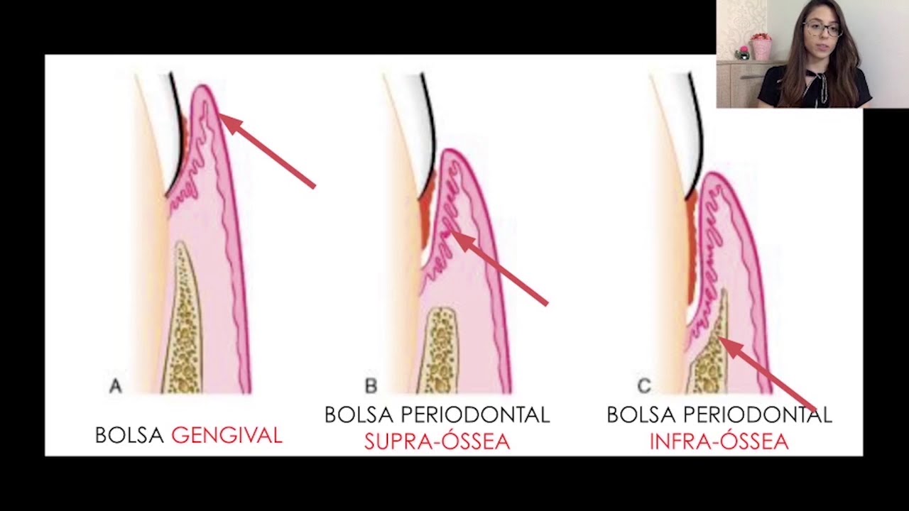 Diagnóstico e Prognóstico das Doenças Periodontais - Parte 1