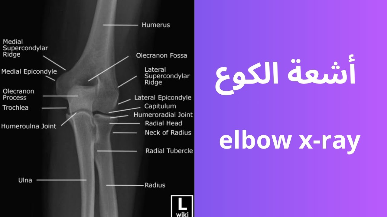 أشعة الكوع | Elbow X-ray – شرح كامل للتشريح والأوضاع الأساسية والخاصة