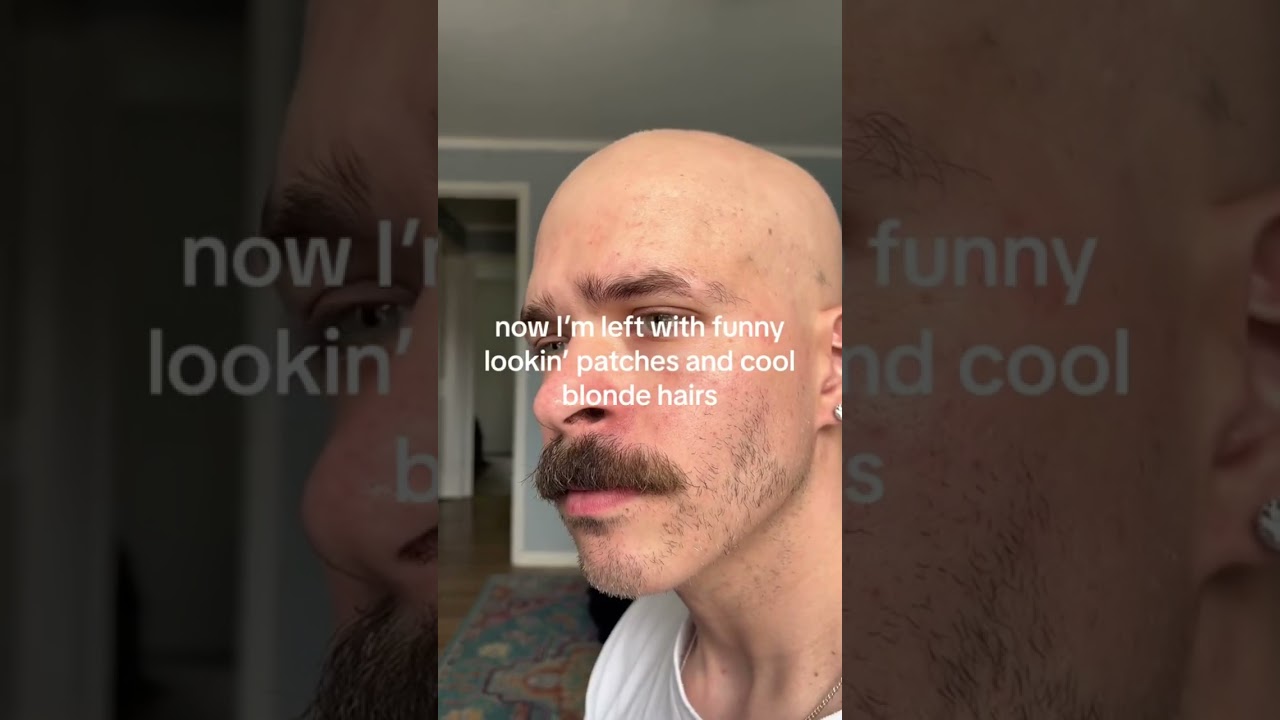 Alopecia