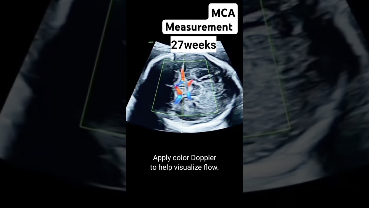 How to measure Middle cerebral artery waveform? #radiology #ultrasound #dopplerultrasound #doppler