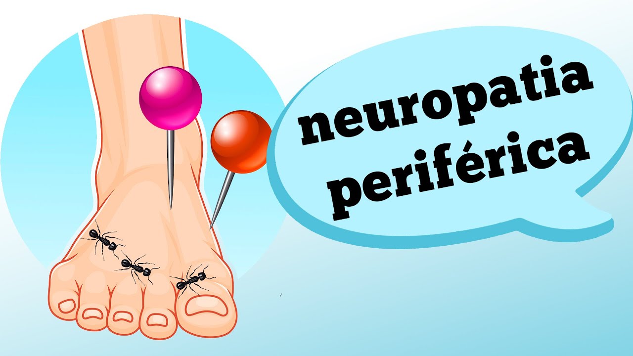 CORPO FORMIGANDO? Causas e sintomas da NEUROPATIA PERIFÉRICA (doença nos nervos)