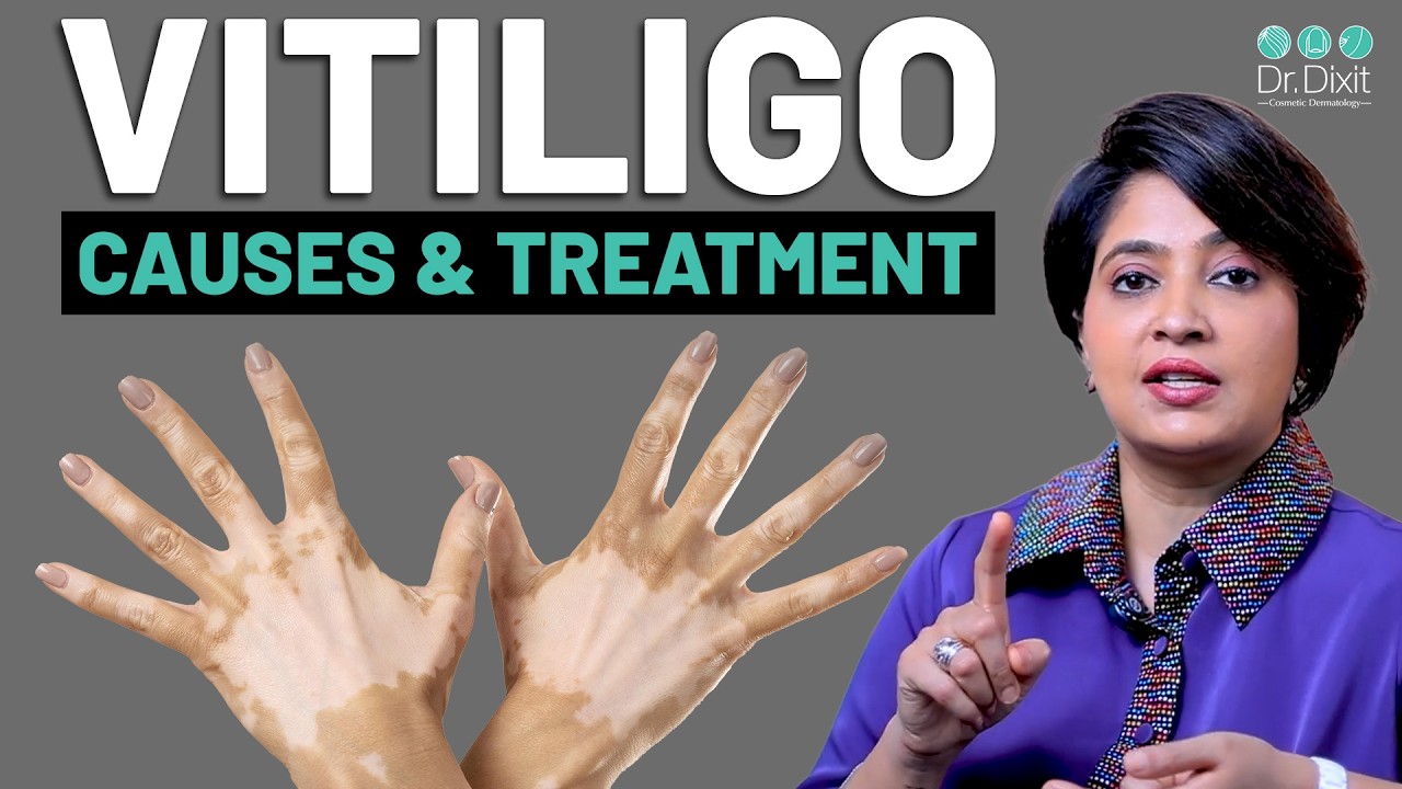 White Patches on Skin (Vitiligo) Explained | Vitiligo Treatment | Dermatologist Dr. Rasya Dixit