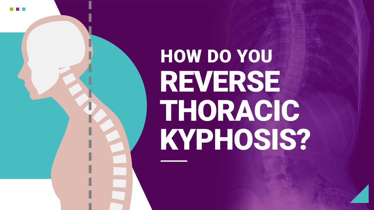 How Do You Reverse Thoracic Kyphosis?