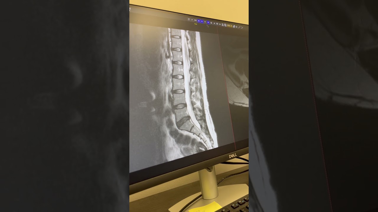 Herniated Disc MRI With Dr. Montero