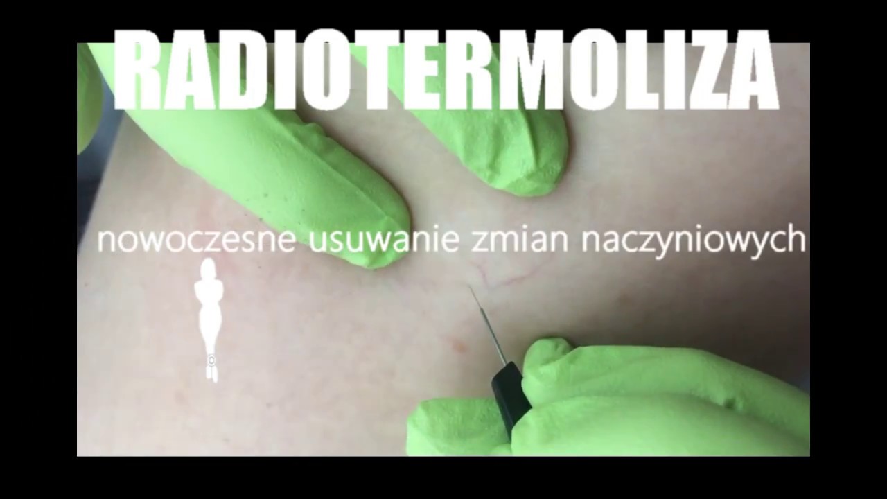 Radiotermoliza - Nowoczesne zamykanie naczyń krwionośnych
