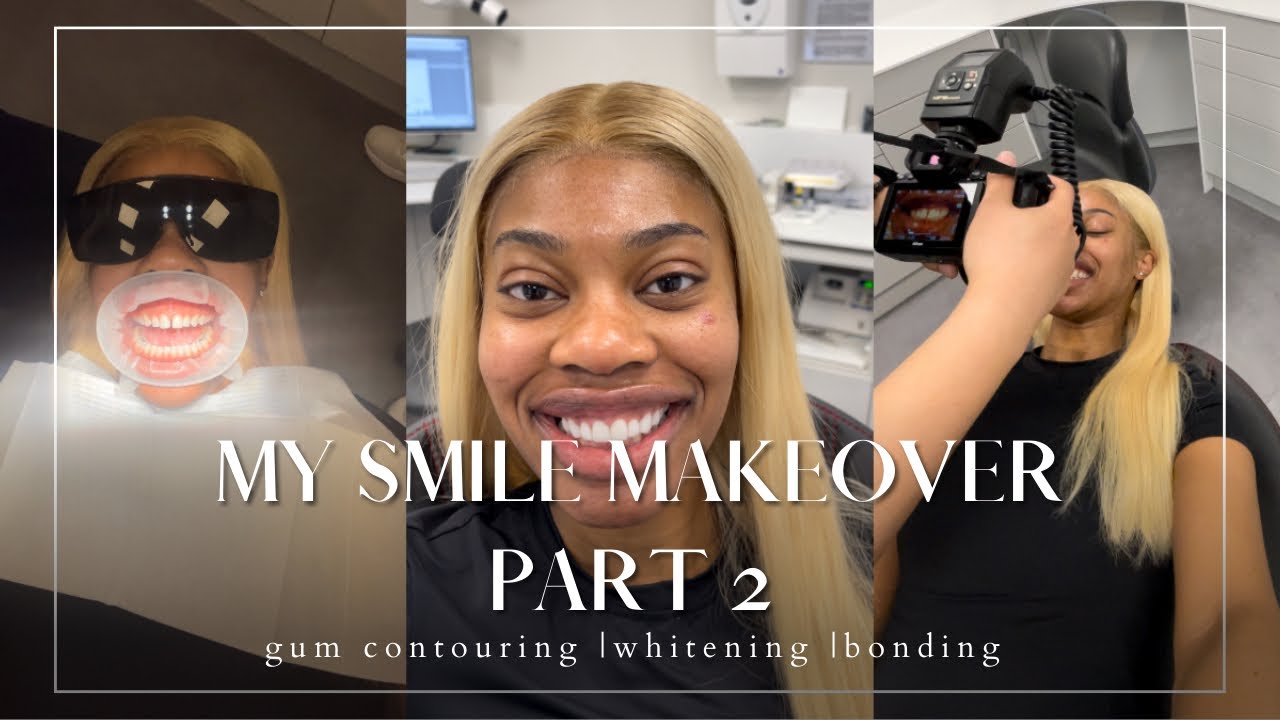 MY SMILE MAKEOVER (PART 2) 😁 | TEETH WHITENING, GUM CONTOURING, COMPOSITE BONDING