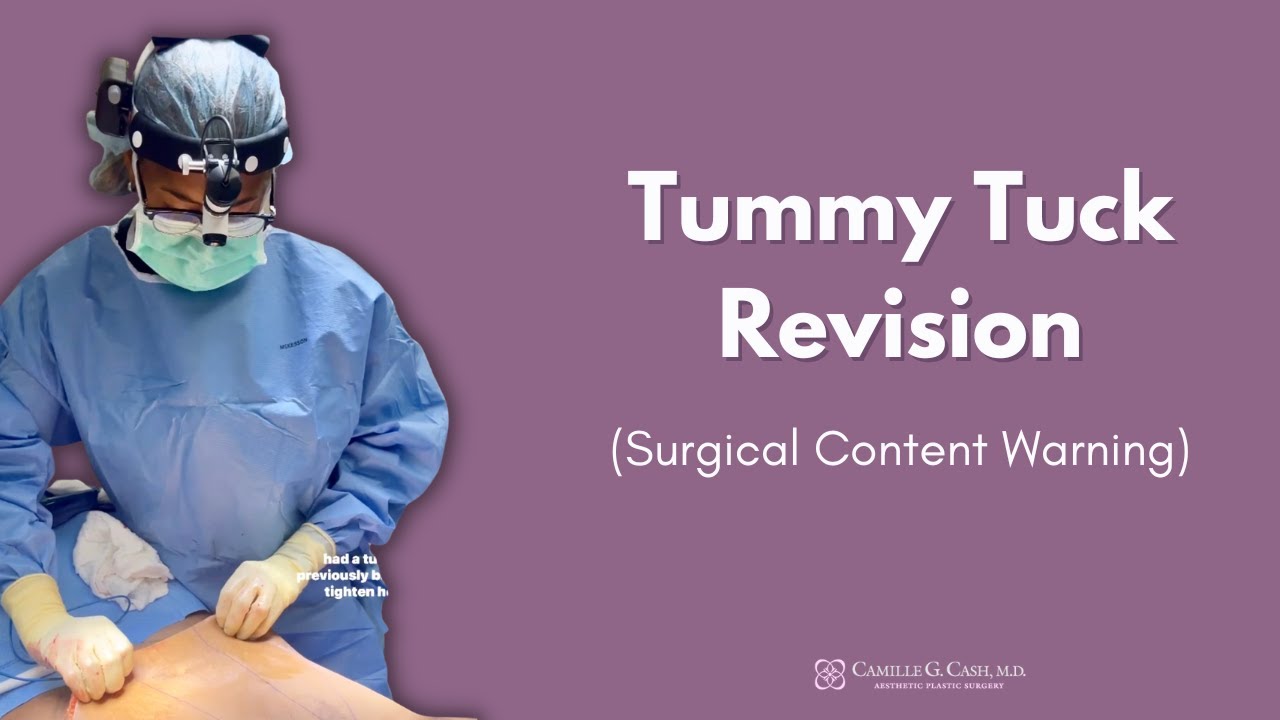 What’s Included In a Tummy Tuck Revision? | Dr. Camille Cash in Houston