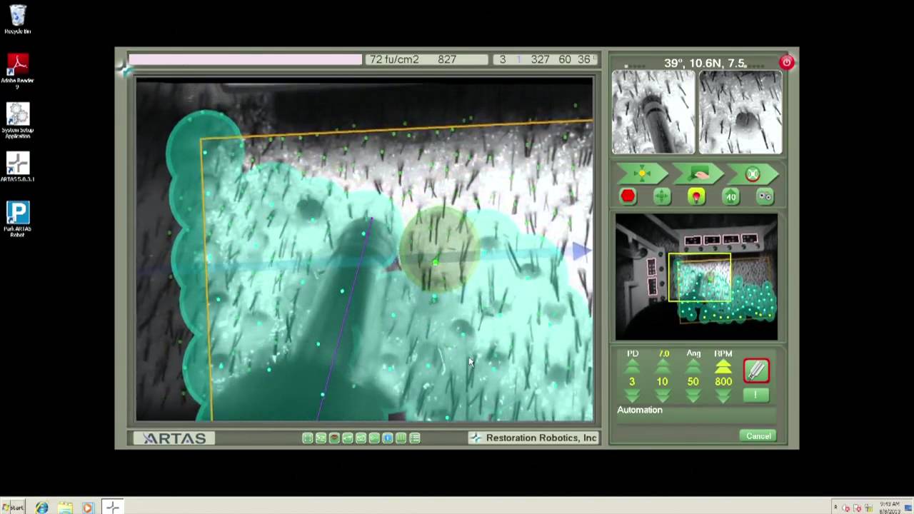 ARTAS® Insights Robotic Hair Transplant Surgeon Series   ARTAS Live with Dr  Mark Bishara
