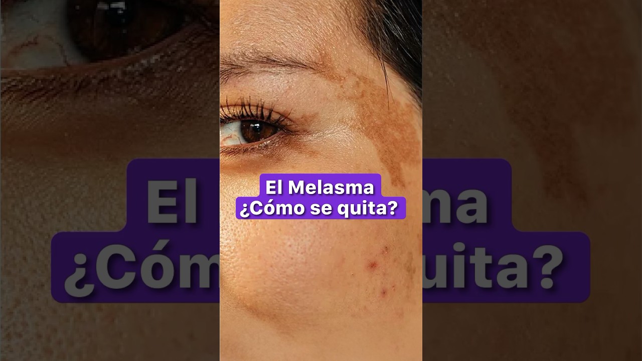 🧑‍⚕️ Los secretos ocultos del melasma #piel #melasma #manchasenlacara
