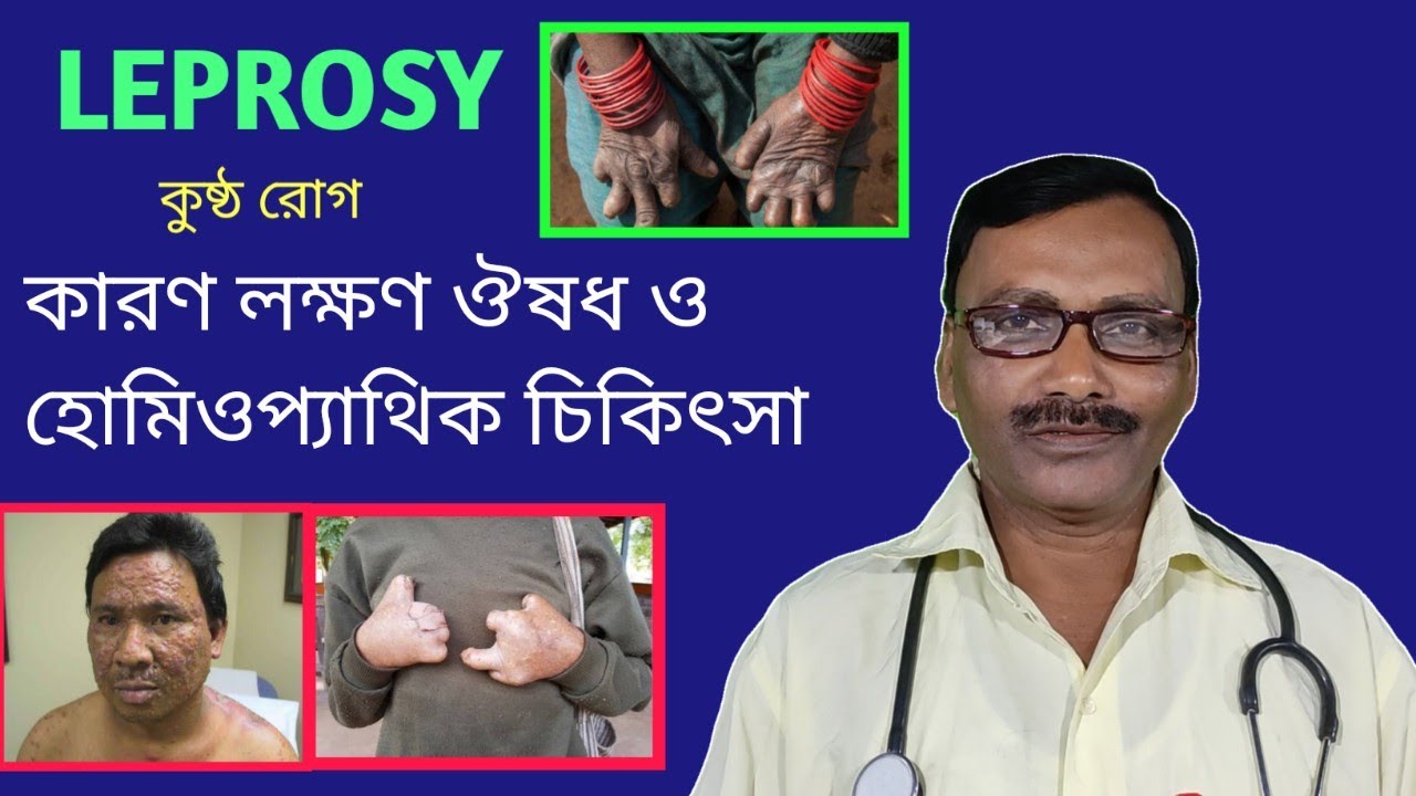 Homeopathic doctor || Leprosy বা কুষ্ঠ রোগের কারণ লক্ষণ ও প্রতিকার || Dr SP Goswami