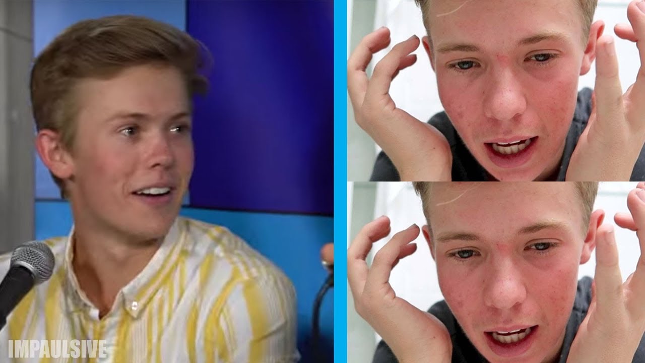 TANNER FOX ON ACNE IMPROVEMENT