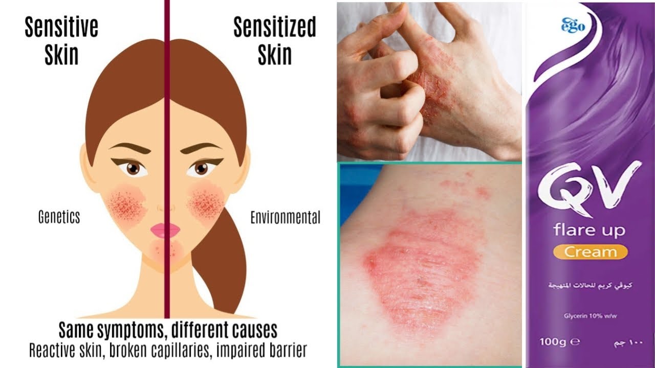 QV Flare Up Cream 100gm