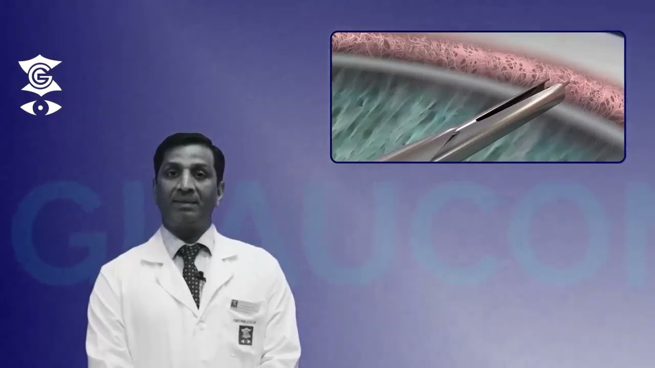 Breaking Down Glaucoma: How the iStent Surgery is Changing the Game   #glaucomaawareness #glaucoma