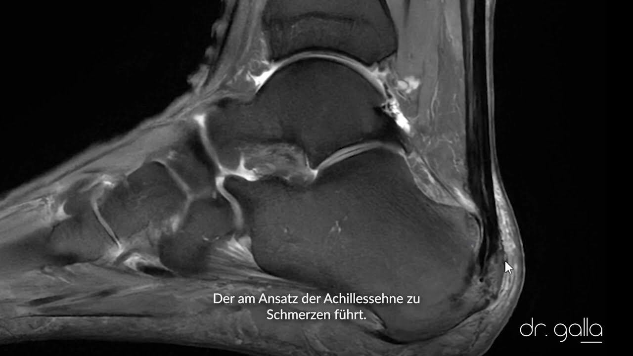 Fersenschmerz - Fußspezialistin Dr. Galla