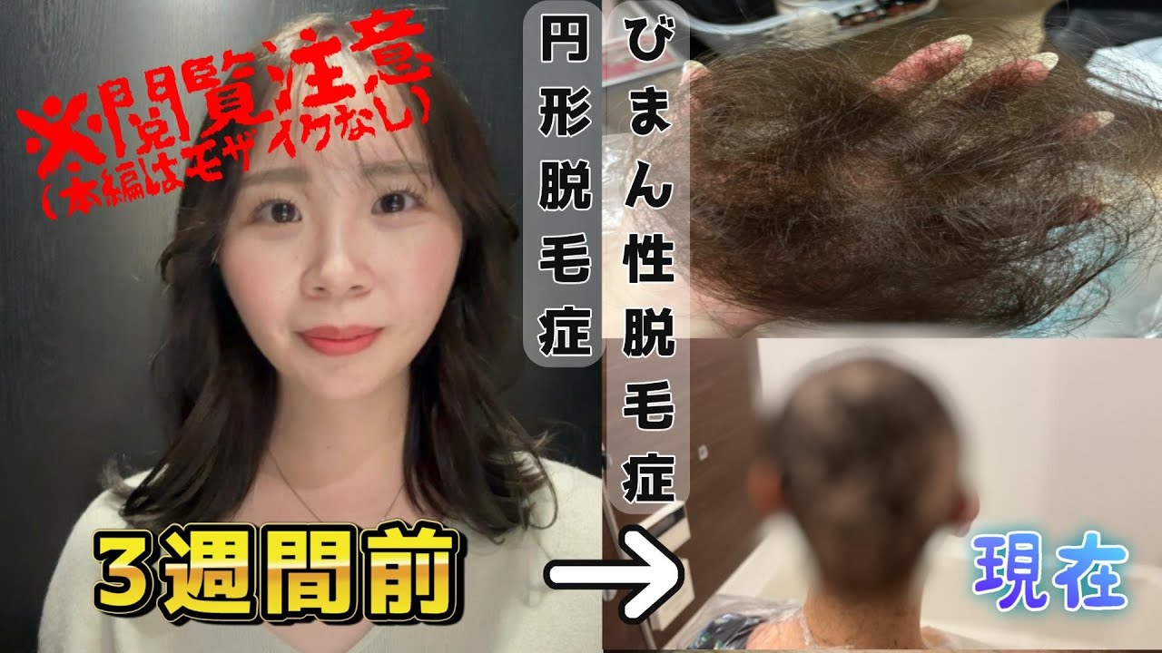 【円形脱毛症・びまん性脱毛症】3週間で別人になった件※閲覧注意