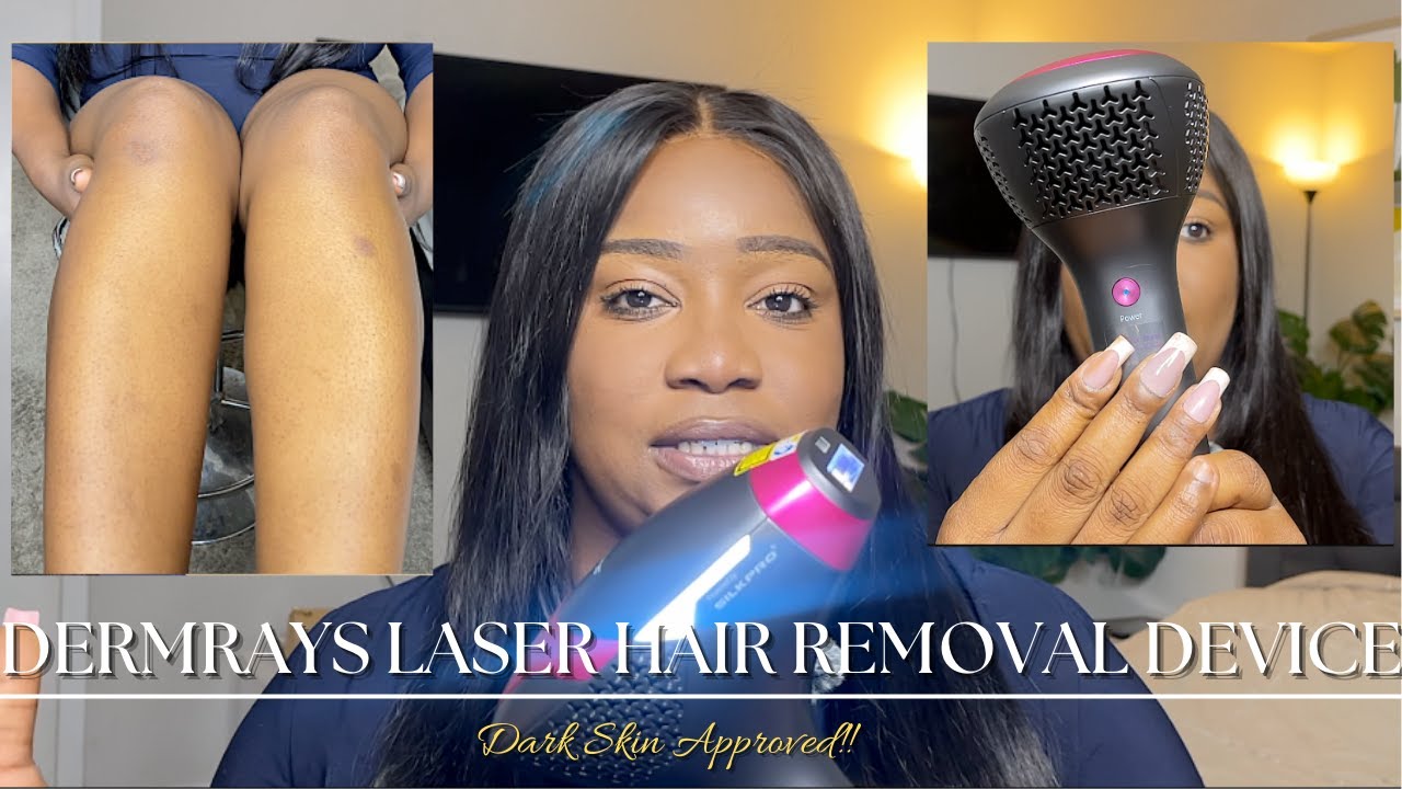 ОБЗОР ЛАЗЕРНОГО УСТРОЙСТВА ДЛЯ ЭПИЛЯЦИИ КОЖИ С МЕЛАНОМ DERM RAYS! СТОИТ ЛИ ОН СВОИХ ДЕНЕГ? Я ДУМА...