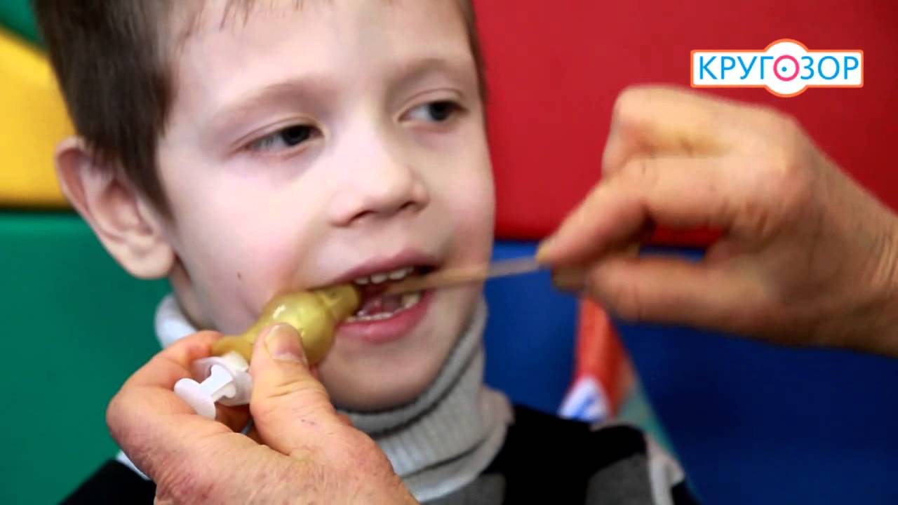 Денисова К.Л. Применение зондозаменителей при коррекции дизартрии