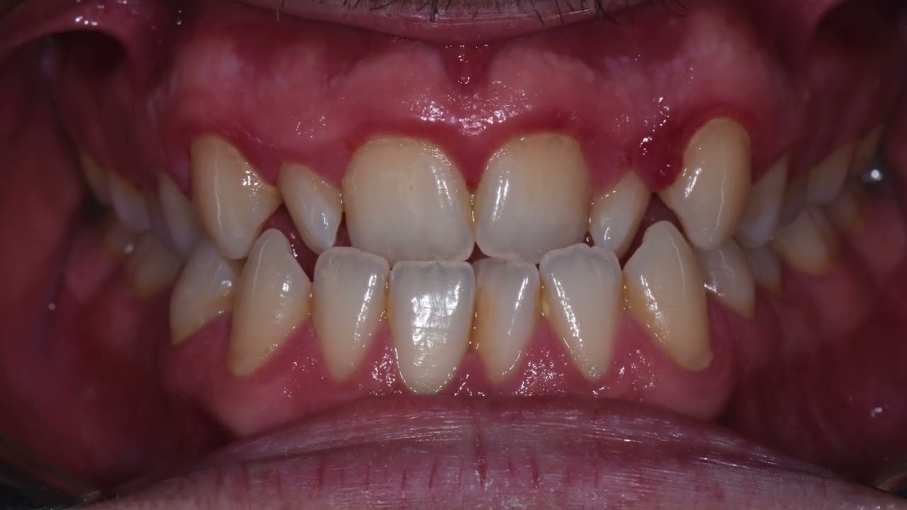 Denti Storti e Infiammazioni Gengivali