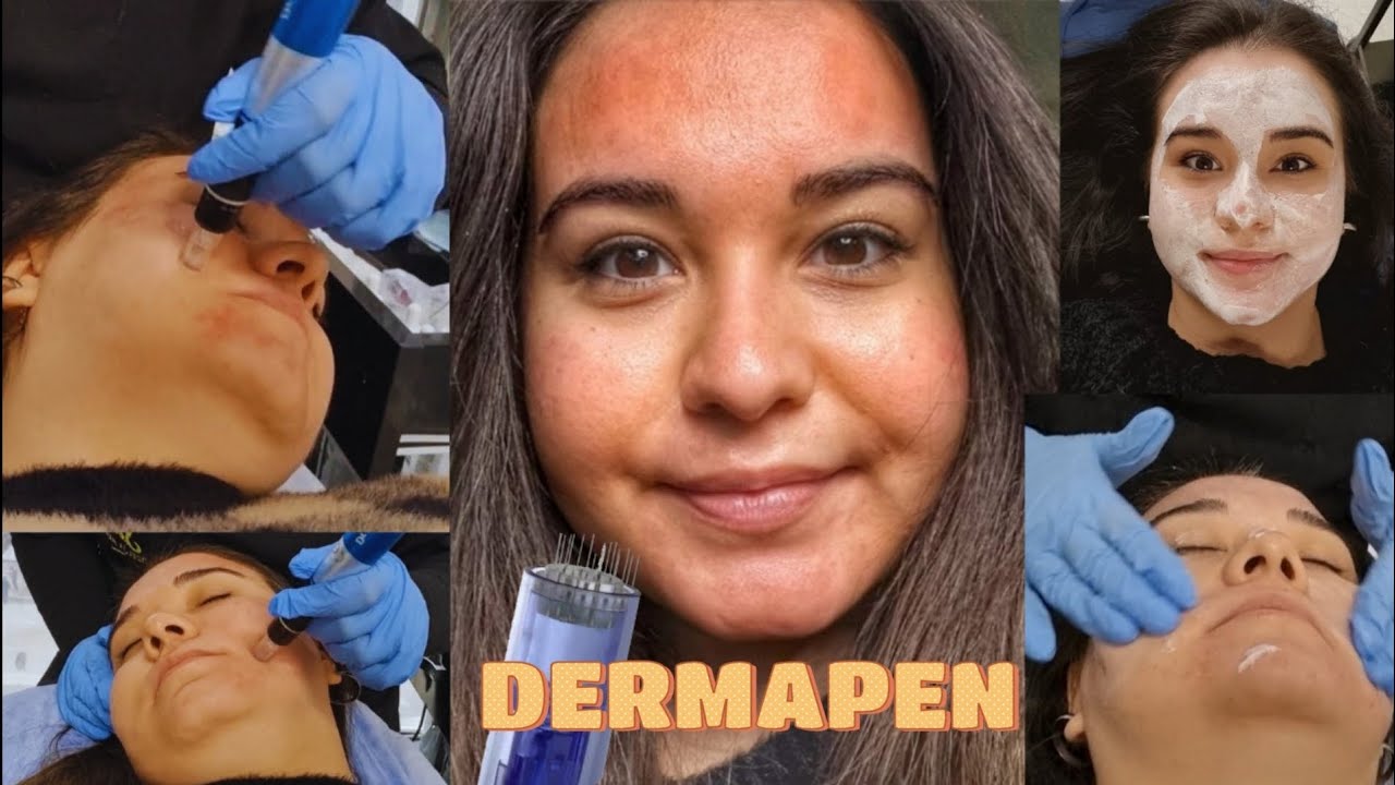 Sivilce Çukurlarım için DERMAPEN Yaptırdım | Ne Kadar Acıdı ve Kızardı ?