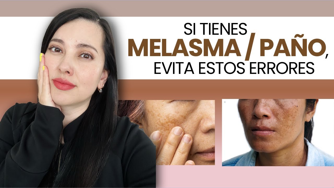 SI TIENES MELASMA, PAÑO, SEGURO ESTAS COMETIENDO ESTOS ERRORES...